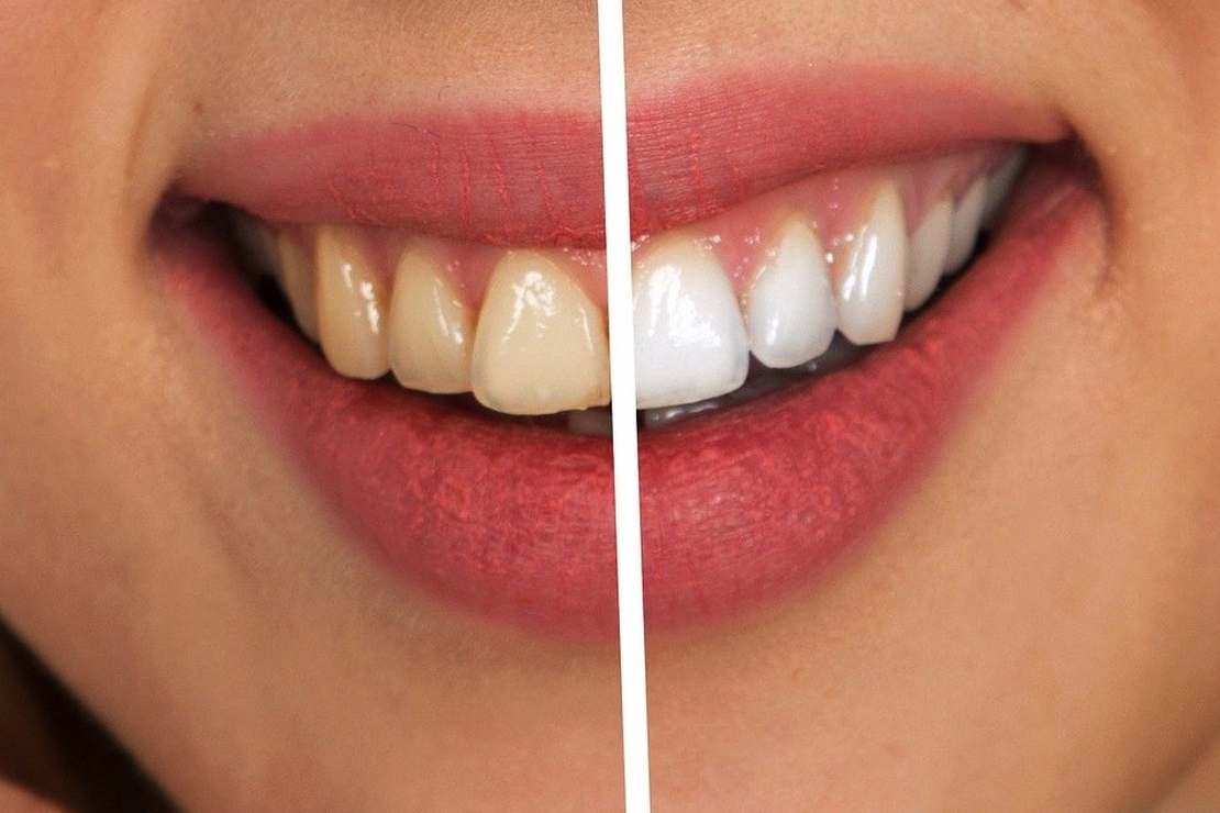 Wybielanie zębów u dentysty - co musisz wiedzieć?