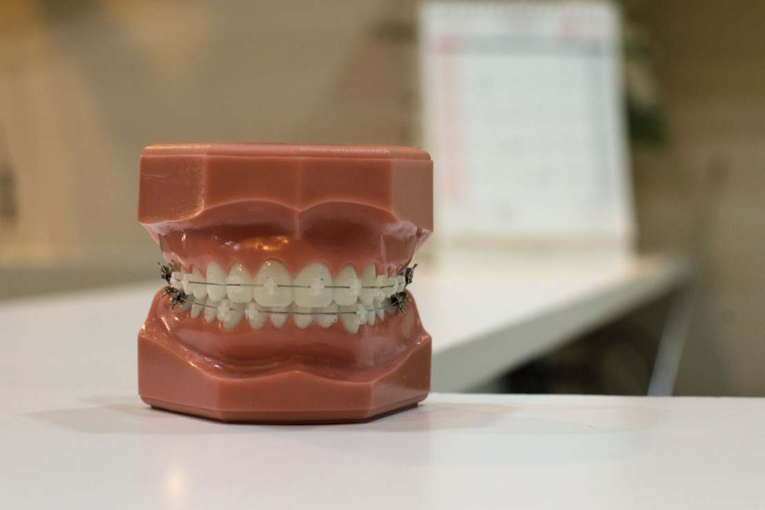 Aparat ortodontyczny – lepszy metalowy czy estetyczny?