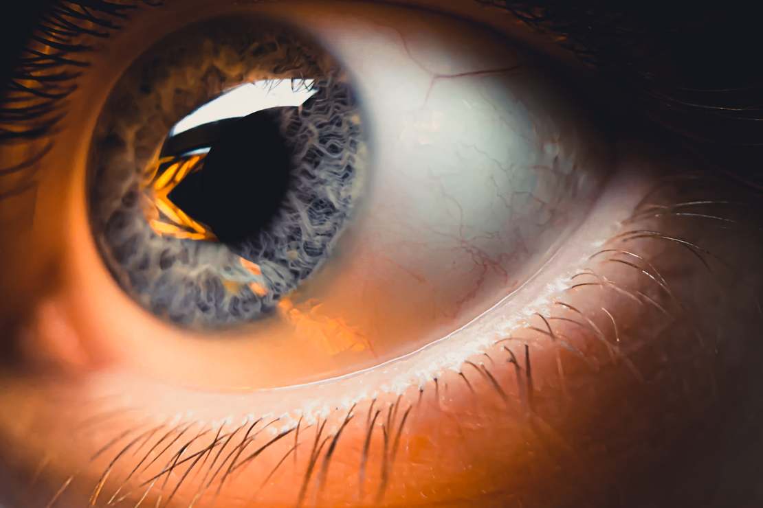 Skuteczny sposób na leczenie astygmatyzmu