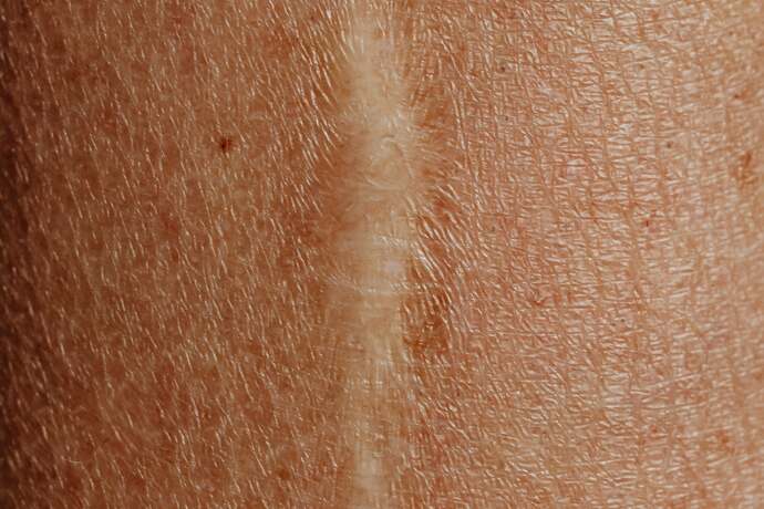 Nowoczesne metody usuwania blizn w gabinecie kosmetycznym