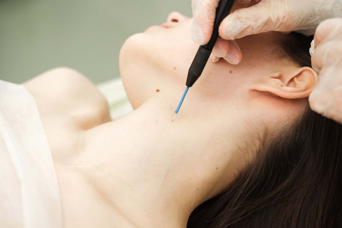 Co to jest elektroagulacja? Kiedy stosuje się ten zabieg?